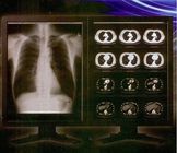 밝은 명확한 디지털 방식으로 엑스레이 영화, Konida 의학 레이저 투명도 영화