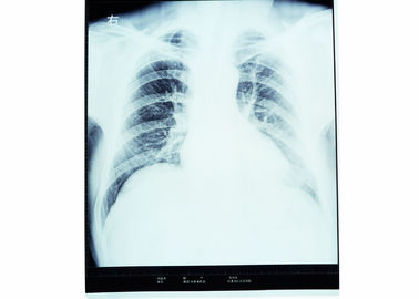 Good price 가슴 AGFA 14in x 17in를 위한 의학 엑스레이 건조한 영화 열 인쇄 기계 온라인으로